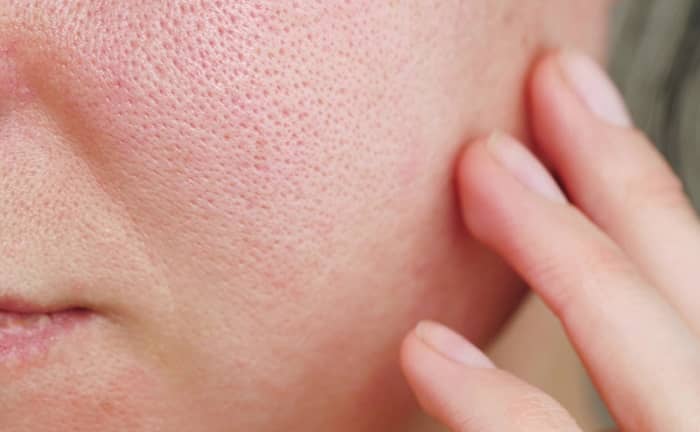 بهترین روش برای درمان منافذ باز پوست